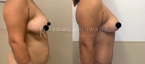 Before & After Result of Breast Reduction Patient #9