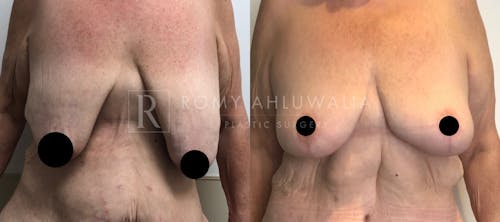 Before & After Result of Breast Reduction Patient #7