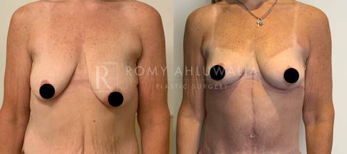 Before & After Result of Breast Reduction Patient #14