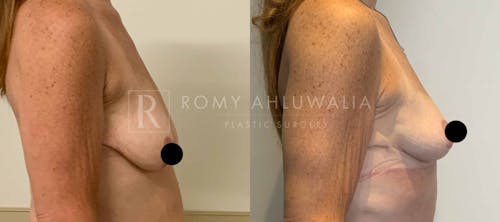 Before & After Result of Breast Reduction Patient #14