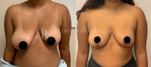 Before & After Result of Breast Reduction Patient #2