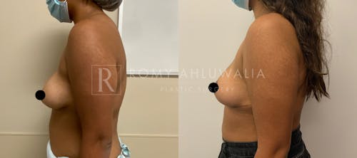 Before & After Result of Breast Reduction Patient #2