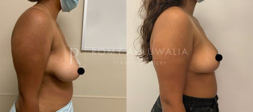 Before & After Result of Breast Reduction Patient #2