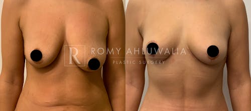 Before & After Result of Breast Reduction Patient #8