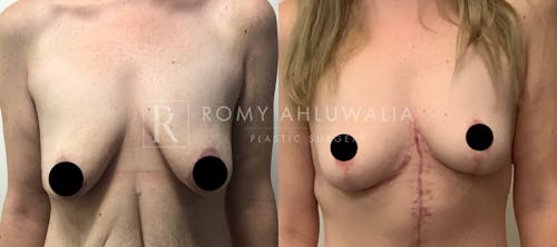 Before & After Result of Breast Reduction Patient #10