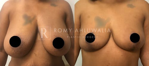 Before & After Result of Breast Reduction Patient #3