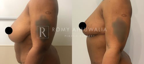 Before & After Result of Breast Reduction Patient #3