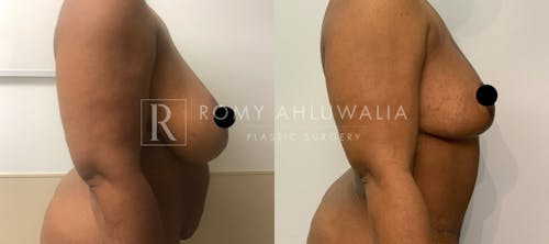 Before & After Result of Breast Reduction Patient #3