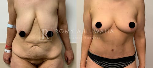 Before & After Result of Breast Reduction Patient #11
