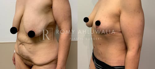 Before & After Result of Breast Reduction Patient #11