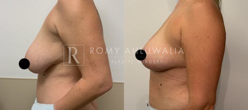 Before & After Result of Breast Reduction Patient #4