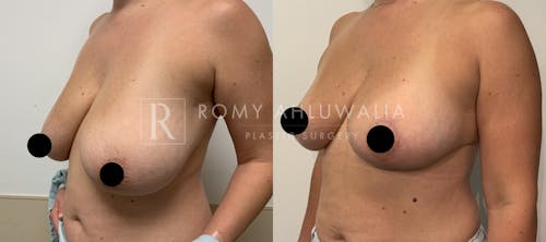 Before & After Result of Breast Reduction Patient #4