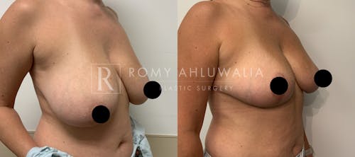 Before & After Result of Breast Reduction Patient #4