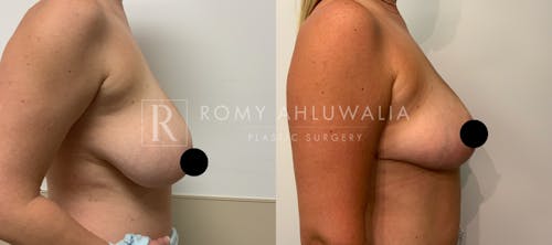 Before & After Result of Breast Reduction Patient #4