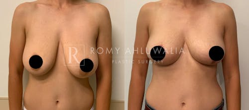 Before & After Result of Breast Reduction Patient #6