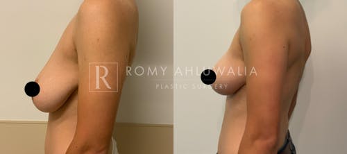 Before & After Result of Breast Reduction Patient #6