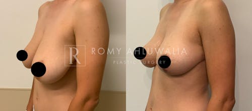 Before & After Result of Breast Reduction Patient #6