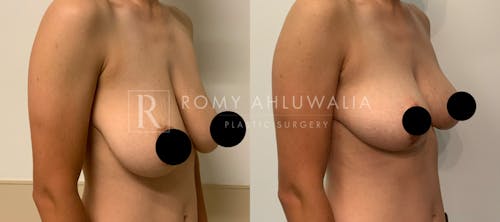 Before & After Result of Breast Reduction Patient #6