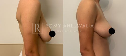 Before & After Result of Breast Reduction Patient #6