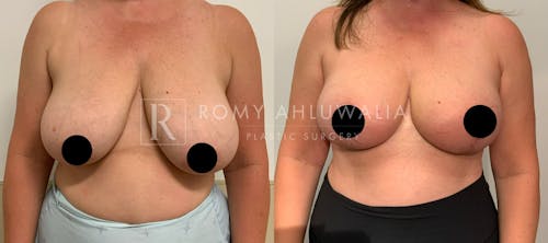 Before & After Result of Breast Reduction Patient #28