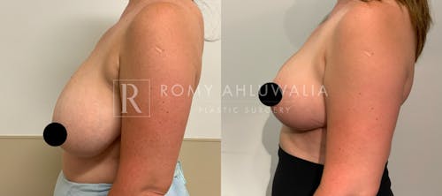 Before & After Result of Breast Reduction Patient #28