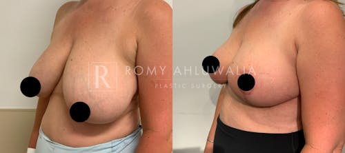 Before & After Result of Breast Reduction Patient #28