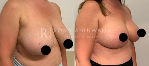 Before & After Result of Breast Reduction Patient #28