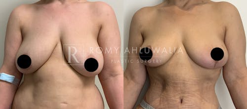 Before & After Result of Breast Reduction Patient #18
