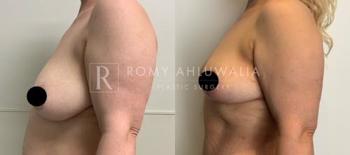 Before & After Result of Breast Reduction Patient #18