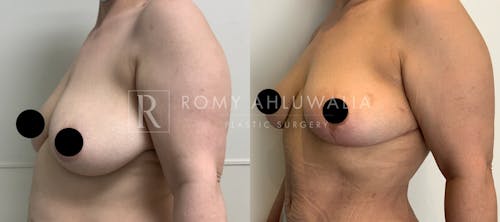Before & After Result of Breast Reduction Patient #18