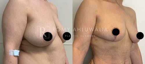 Before & After Result of Breast Reduction Patient #18