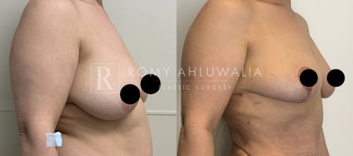 Before & After Result of Breast Reduction Patient #18