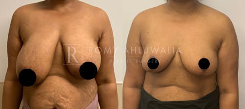 Before & After Result of Breast Reduction Patient #16