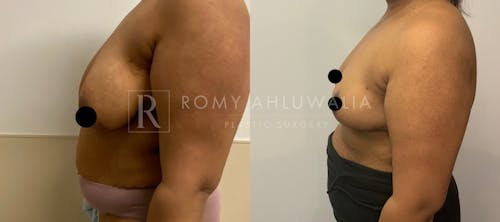 Before & After Result of Breast Reduction Patient #16