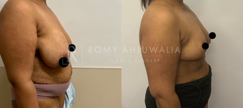 Before & After Result of Breast Reduction Patient #16