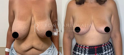Before & After Result of Breast Reduction Patient #31