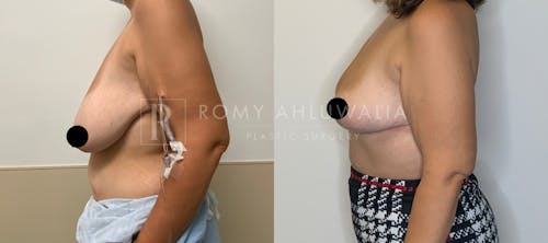 Before & After Result of Breast Reduction Patient #31