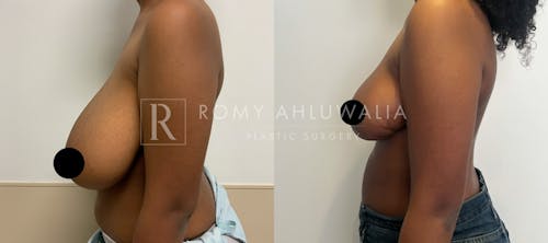 Before & After Result of Breast Reduction Patient #22