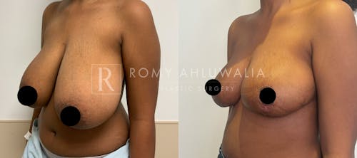 Before & After Result of Breast Reduction Patient #22