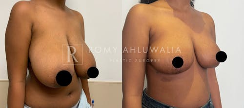 Before & After Result of Breast Reduction Patient #22