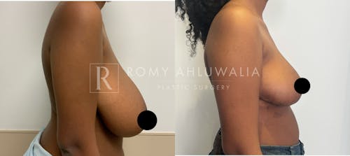 Before & After Result of Breast Reduction Patient #22