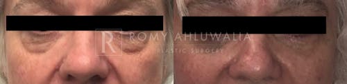 Before & After Result of Lower Eyelid Surgery Patient #1