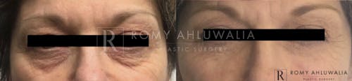 Before & After Result of Lower Eyelid Surgery Patient #2
