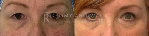 Before & After Result of Upper Eyelid Surgery Patient #3