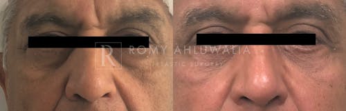 Before & After Result of Lower Eyelid Surgery Patient #5