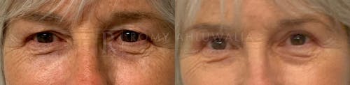 Before & After Result of Upper Eyelid Surgery Patient #6