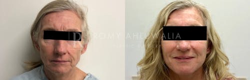 Before & After Result of Facelift Patient #5
