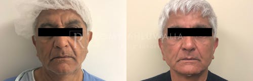 Before & After Result of Facelift Patient #12