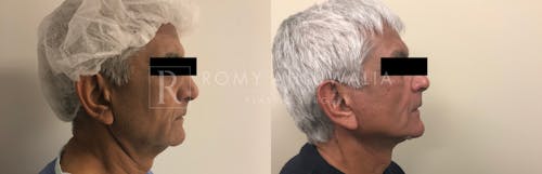 Before & After Result of Facelift Patient #12