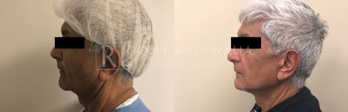Before & After Result of Facelift Patient #12